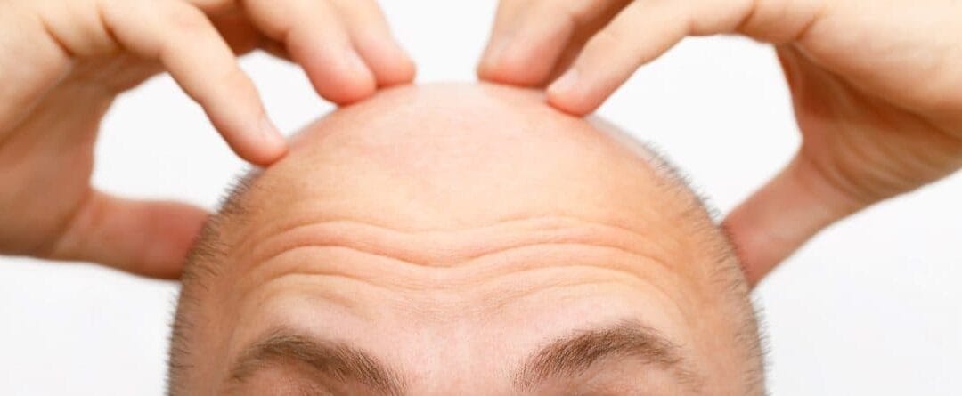 De juiste kandidaat voor een haartransplantatie behandeling?
