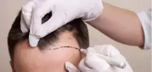 Wat is de beste leeftijd om een haartransplantatie te ondergaan