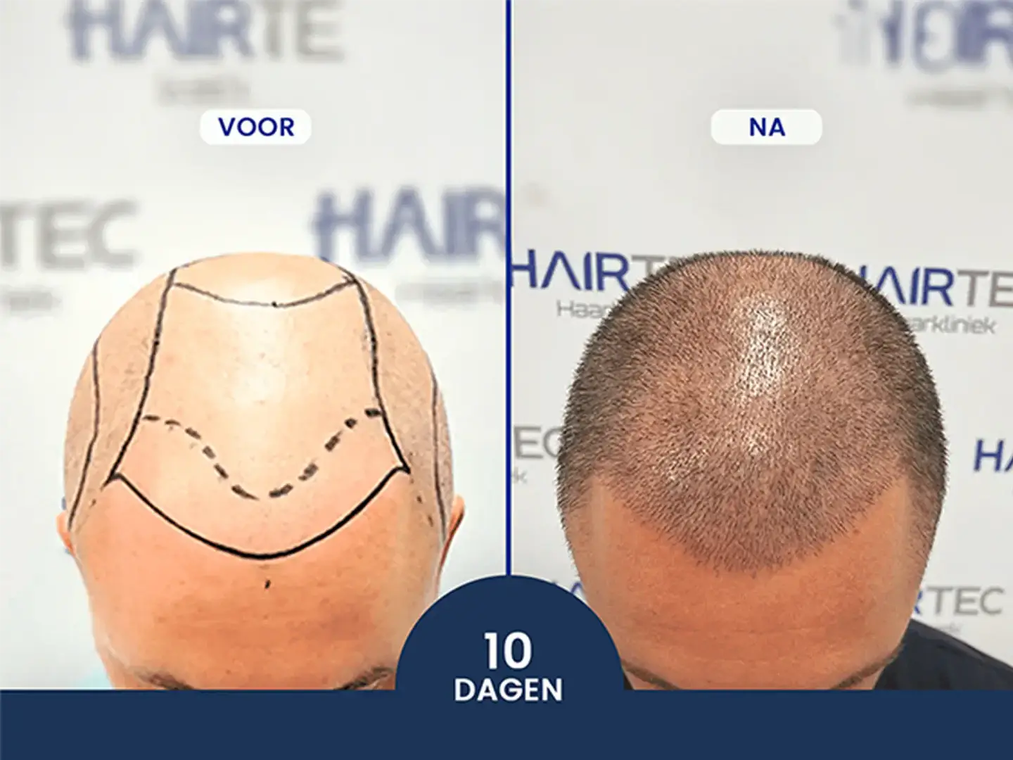 haartransplantatie behandeling