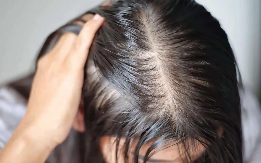 Haarverlies bij vrouwen