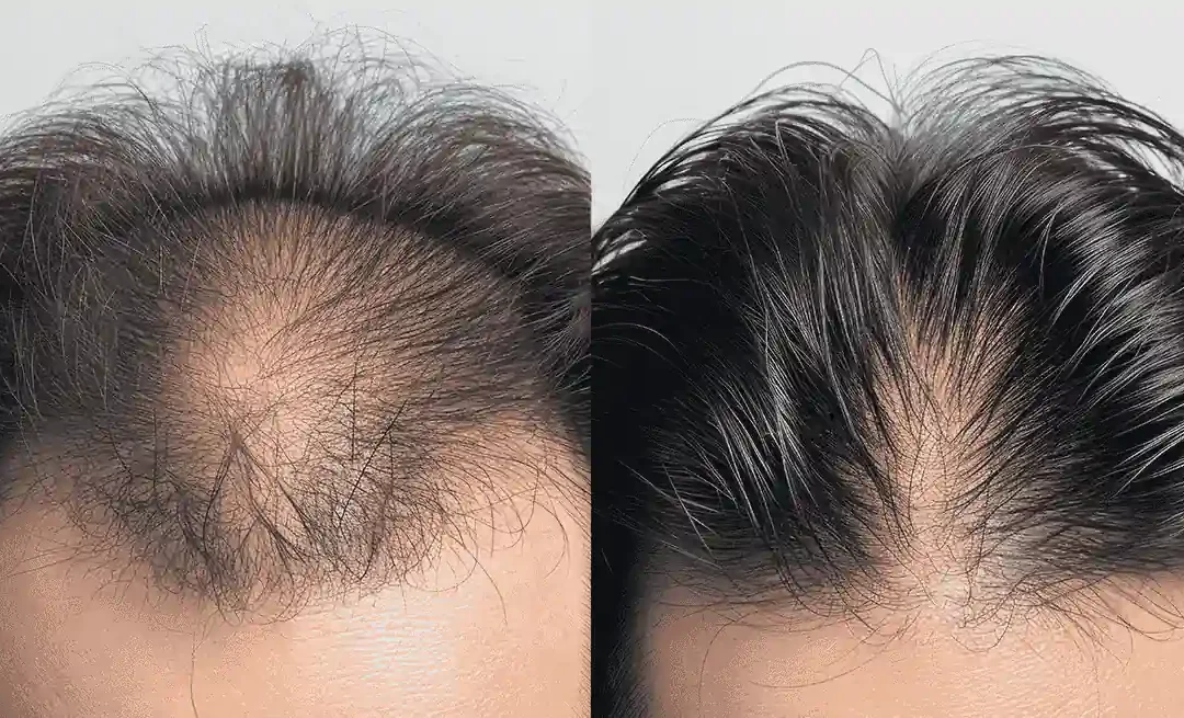 Haartransplantatie bij inhammen