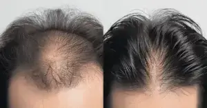 haartransplantatie bij inhammen