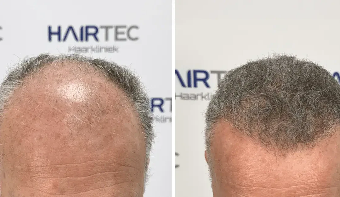 Haartransplantatie hoe lang herstel