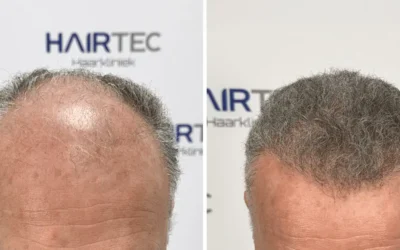 Haartransplantatie hoe lang herstel