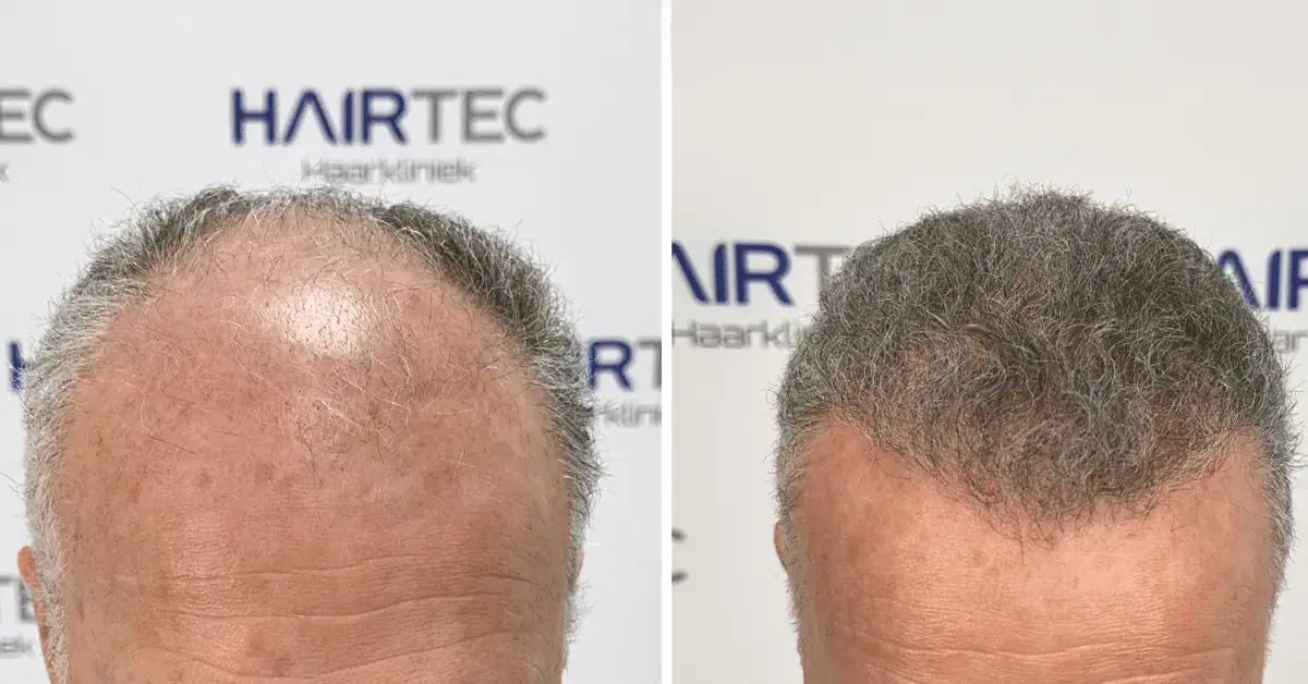 haartransplantatie hoe lang herstel