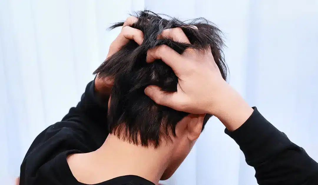 Jeuk na een haartransplantatie