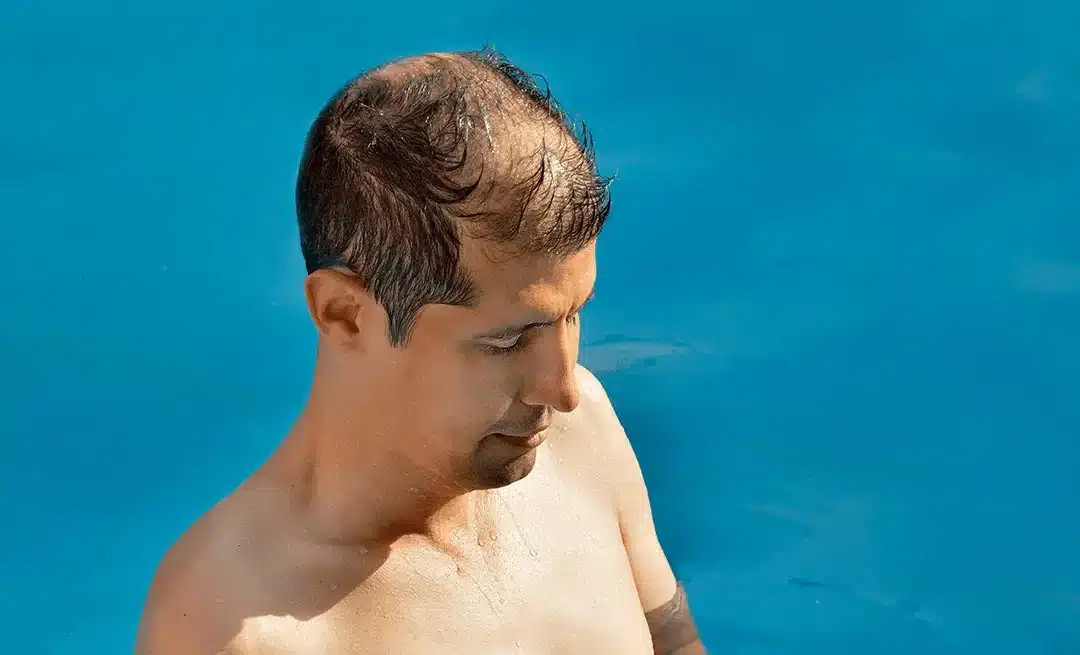 Hoe lang niet in de zon na haartransplantatie