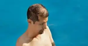 hoe lang niet in de zon na haartransplantatie