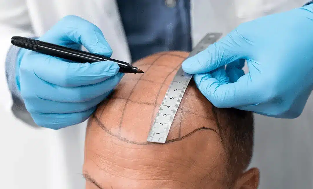 Wat zijn haartransplantatie nadelen?