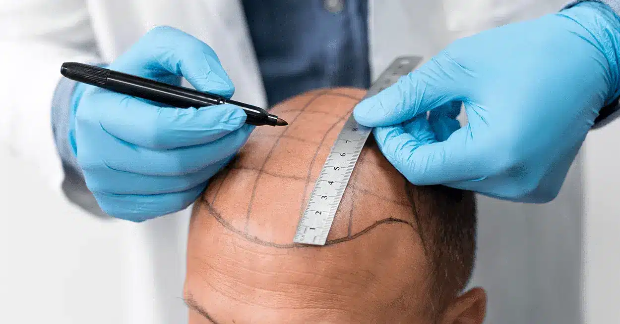 wat zijn haartransplantatie nadelen