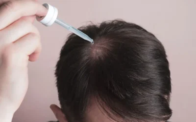 Minoxidil een wondermiddel?