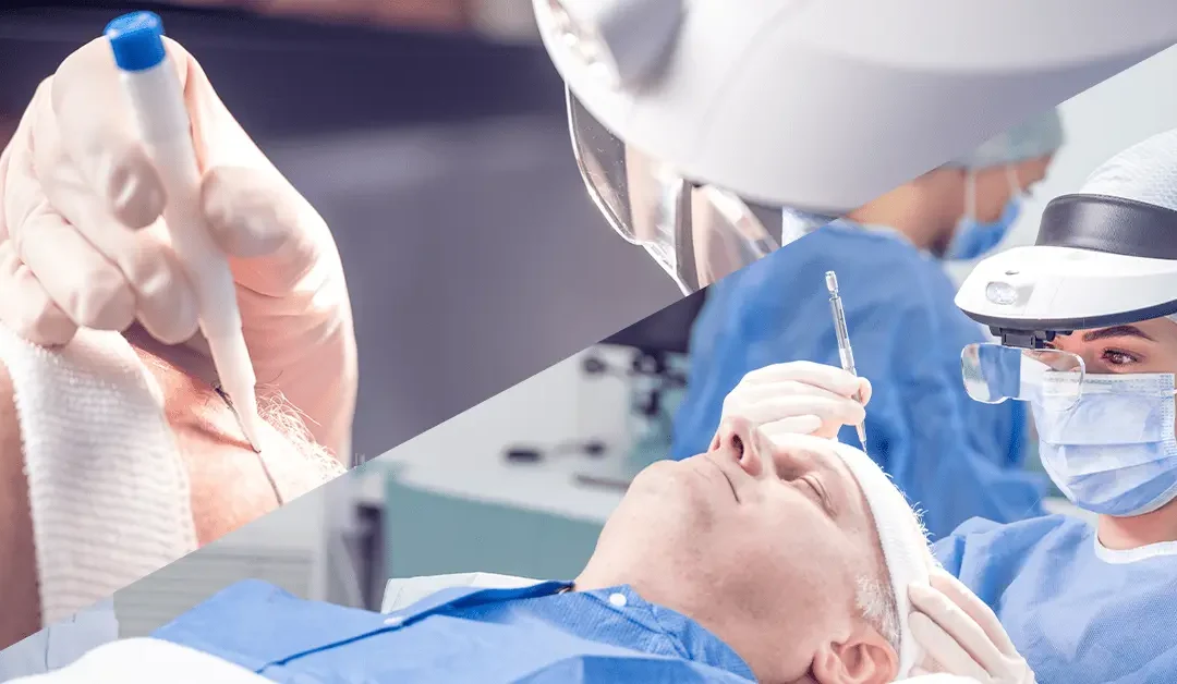 De drie meest toegepaste haartransplantatietechnieken in detail