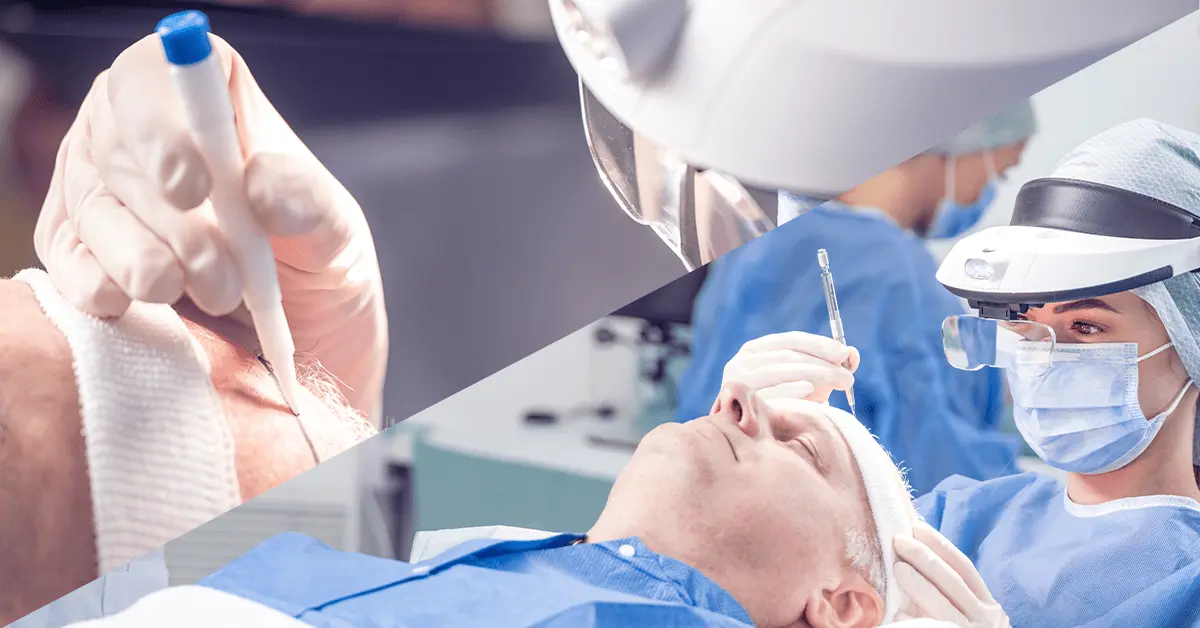 dhi vs fue haartransplantatie