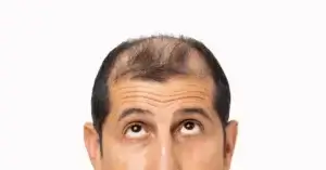 is een haartransplantatie gevaarlijk