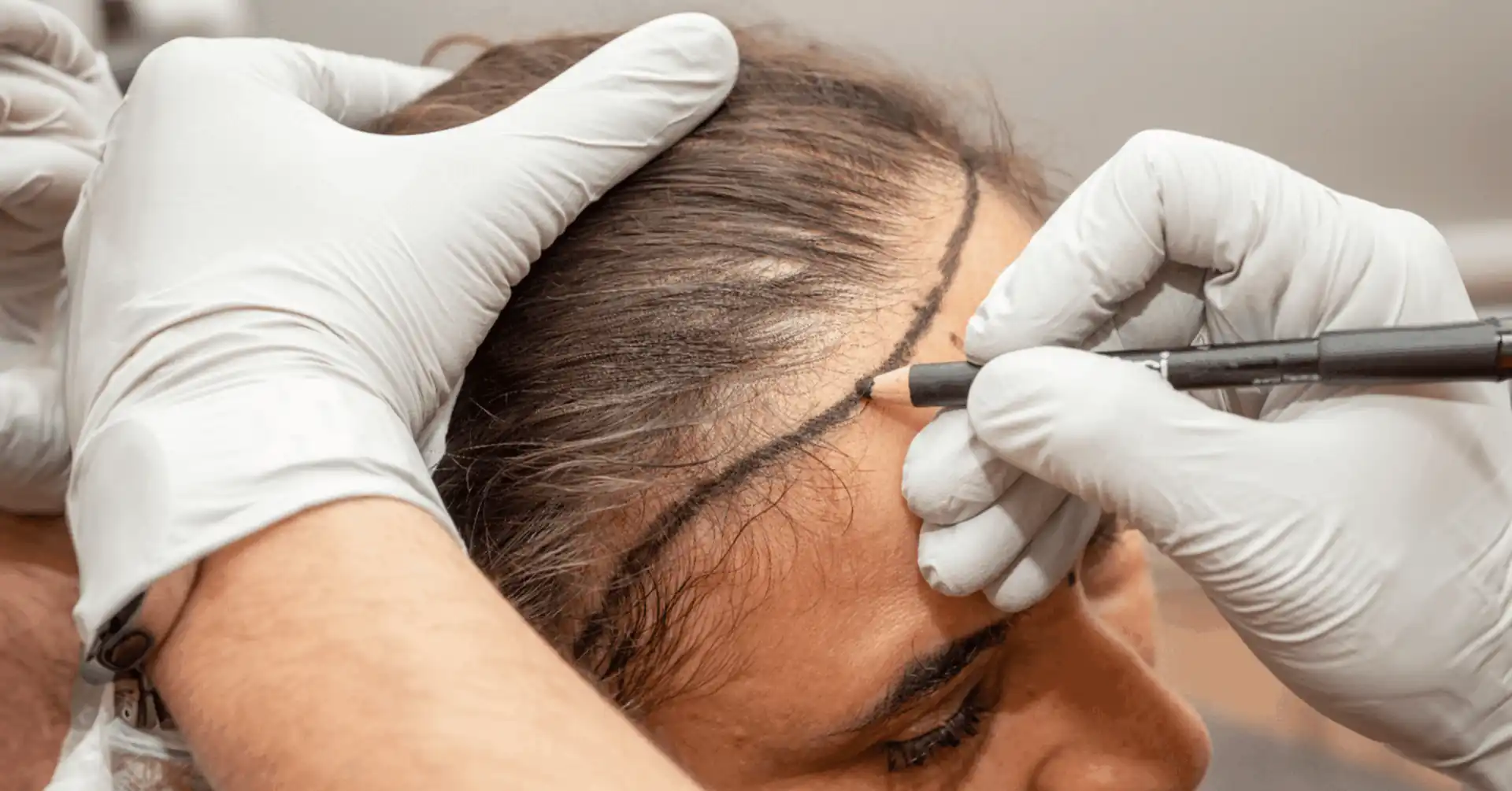 de haaranalyse de haaranalyse
