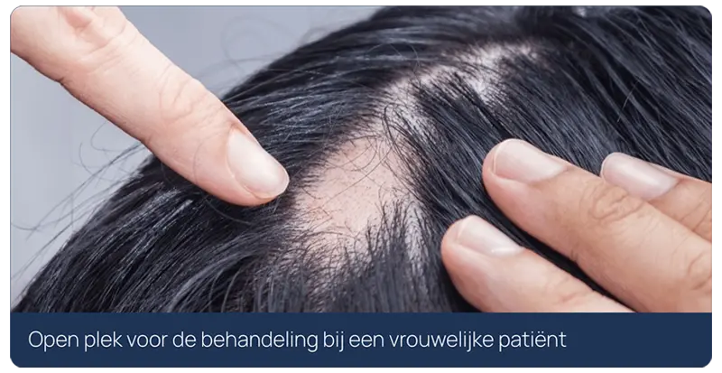 open plek voor de haartransplantatie behandeling open plek voor de haartransplantatie behandeling