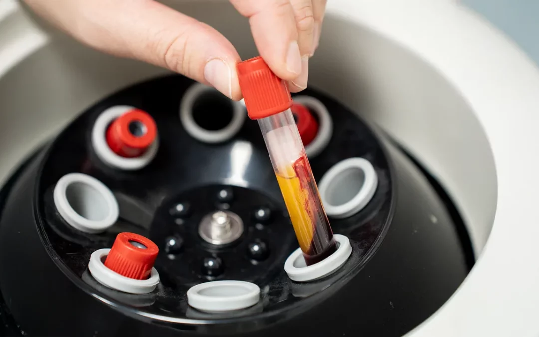 Mesotherapie haar ervaringen