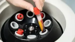 mesotherapie haar ervaringen