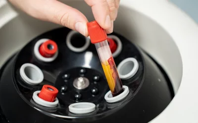 Mesotherapie haar ervaringen