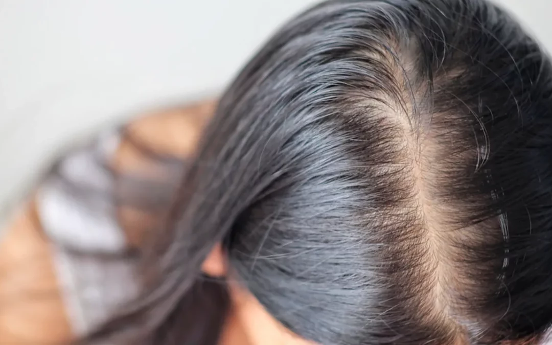 Alopecia androgenetica