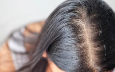 Alopecia androgenetica