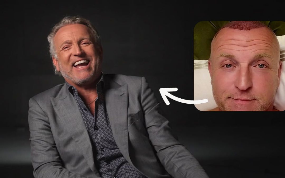 Heeft Gordon een haartransplantatie gedaan?