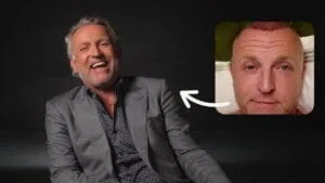 gordon haartransplantatie techniek