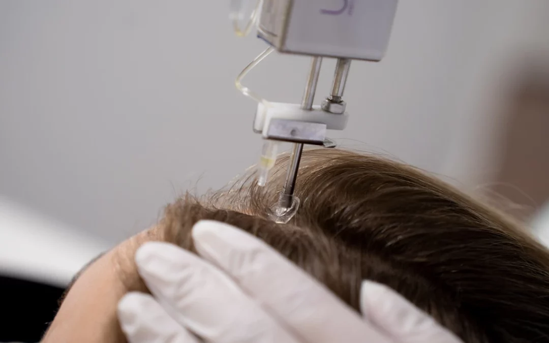 Mesotherapie haar voor en na
