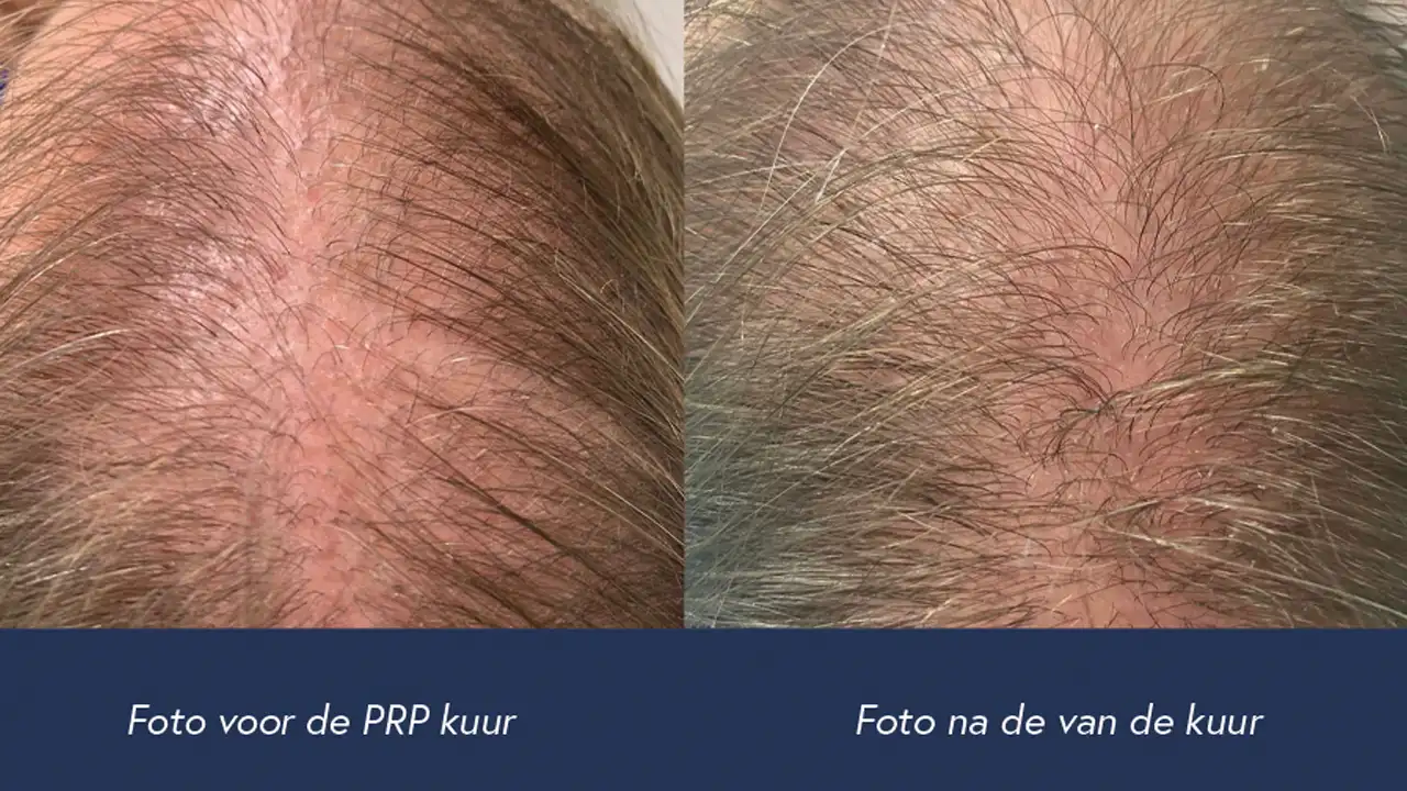 mesotherapie haar voor en na resultaten