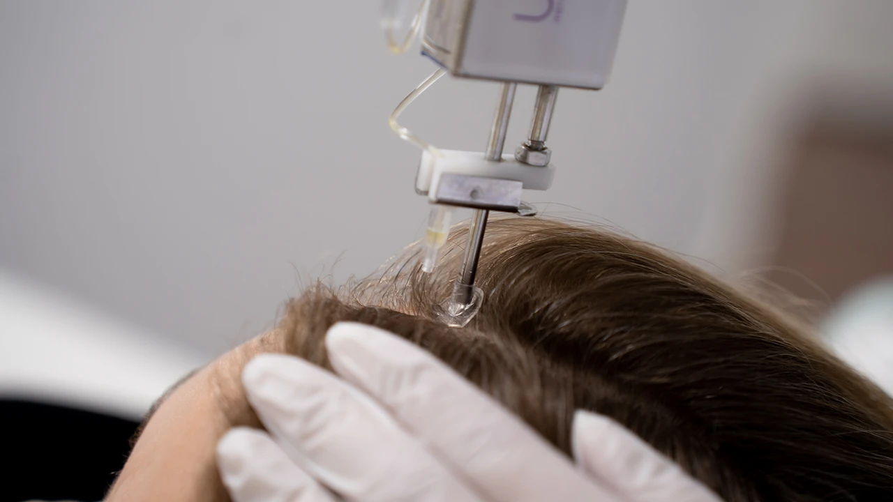 mesotherapie haar voor en na
