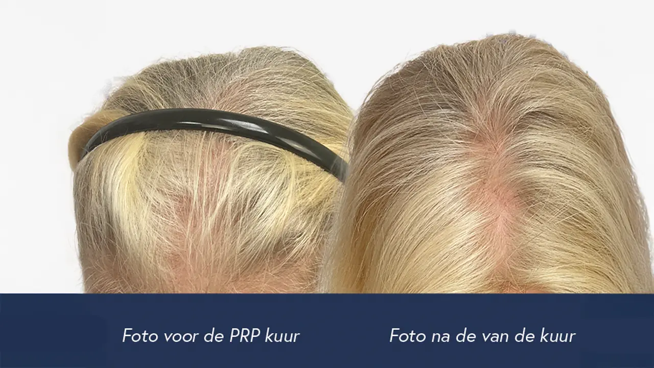 mesotherapie resultaten