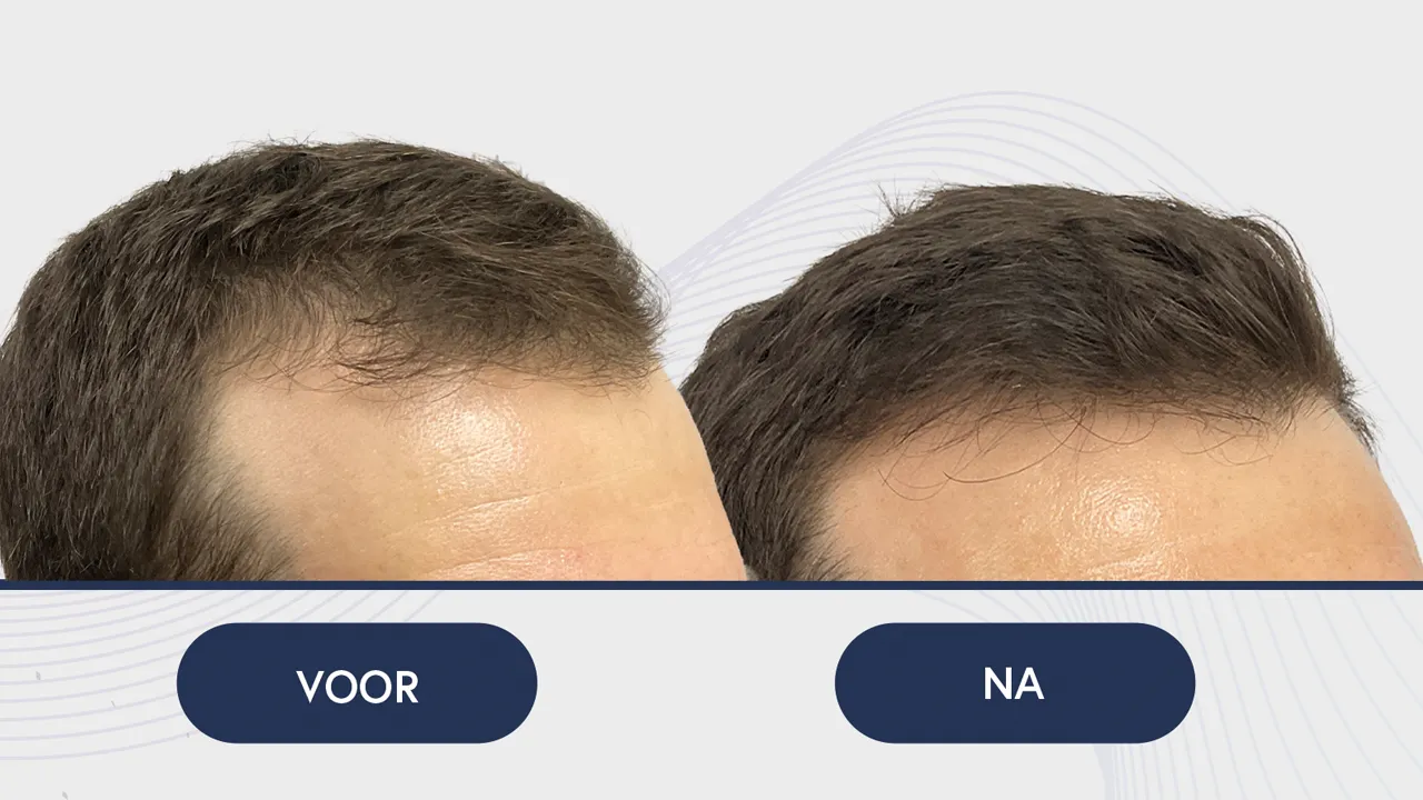 mesotherapie voor en na fotos