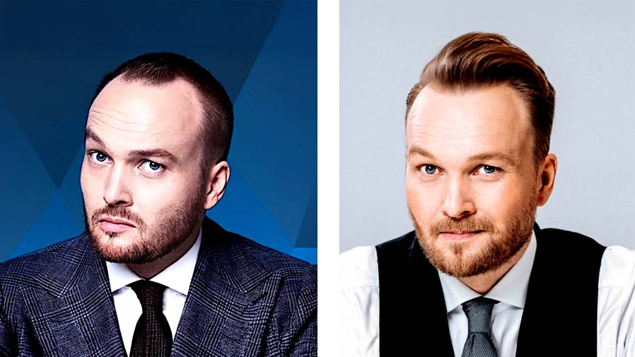 arjen lubach haartransplantatie voor en na