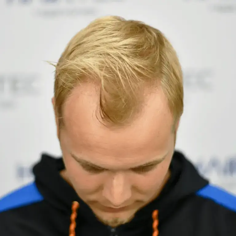 goot voor en na photos voor