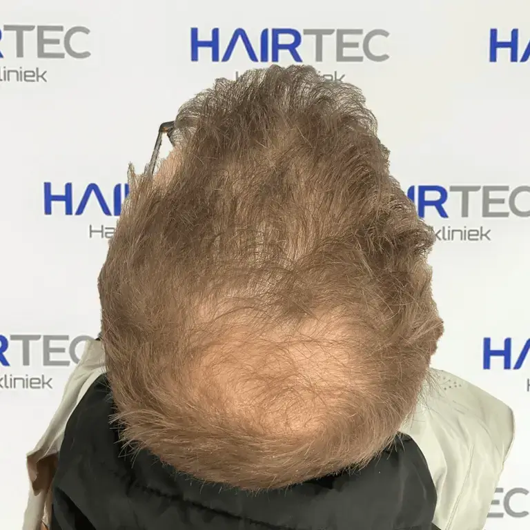 graaf voor en na photo voor