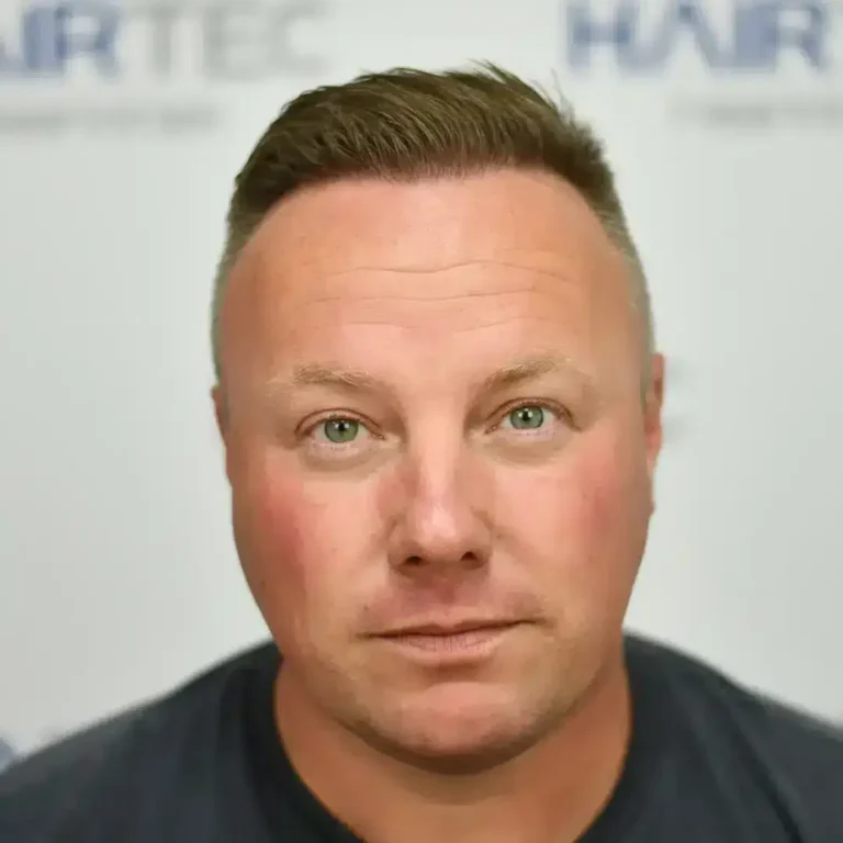 12 maanden na de haartransplantatie, 2.650 grafts