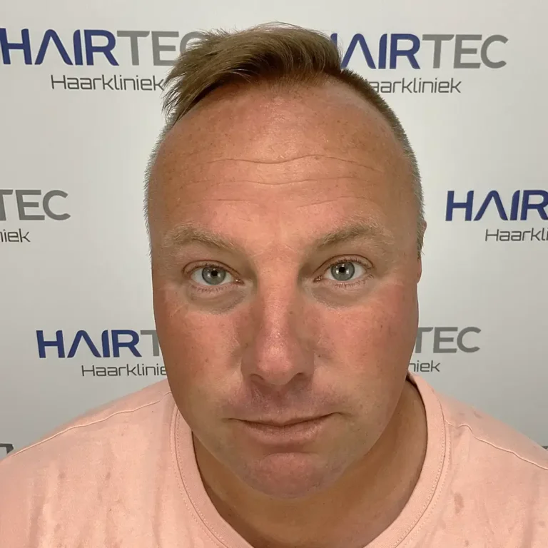Vóór de haartransplantatie, 2.650 grafts