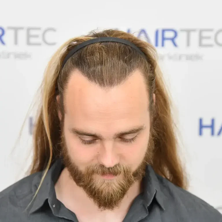 12 maanden na de haartransplantatie, 1.515 grafts