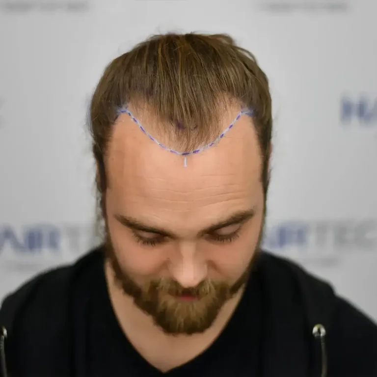 Vóór de haartransplantatie, 1.515 grafts
