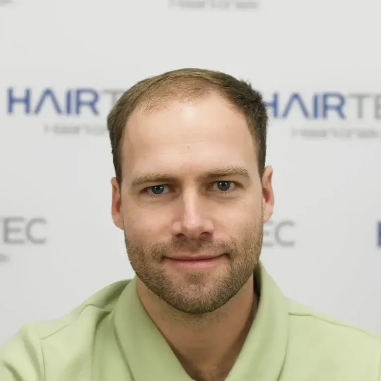 Vóór de haartransplantatie, 3.695 grafts
