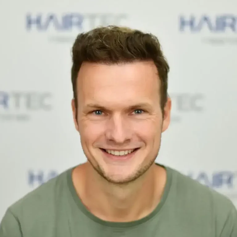 12 maanden na de haartransplantatie, 4.471 grafts