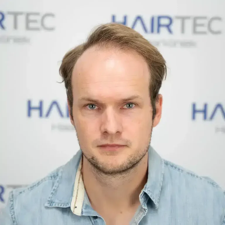 Vóór de haartransplantatie, 4.471 grafts