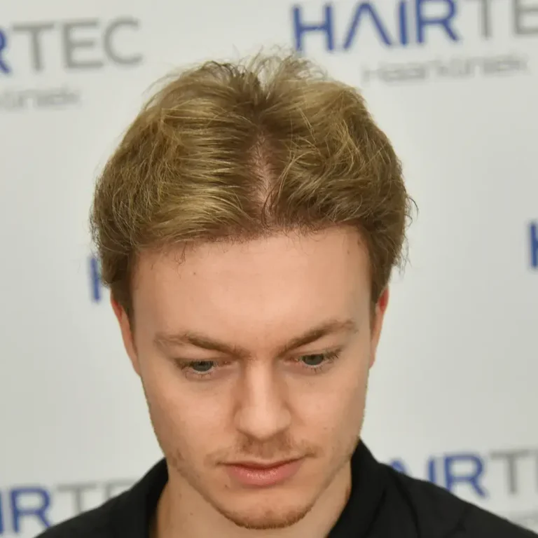 Jurriaan 12 maanden na de haartransplantatie, 2.330 grafts