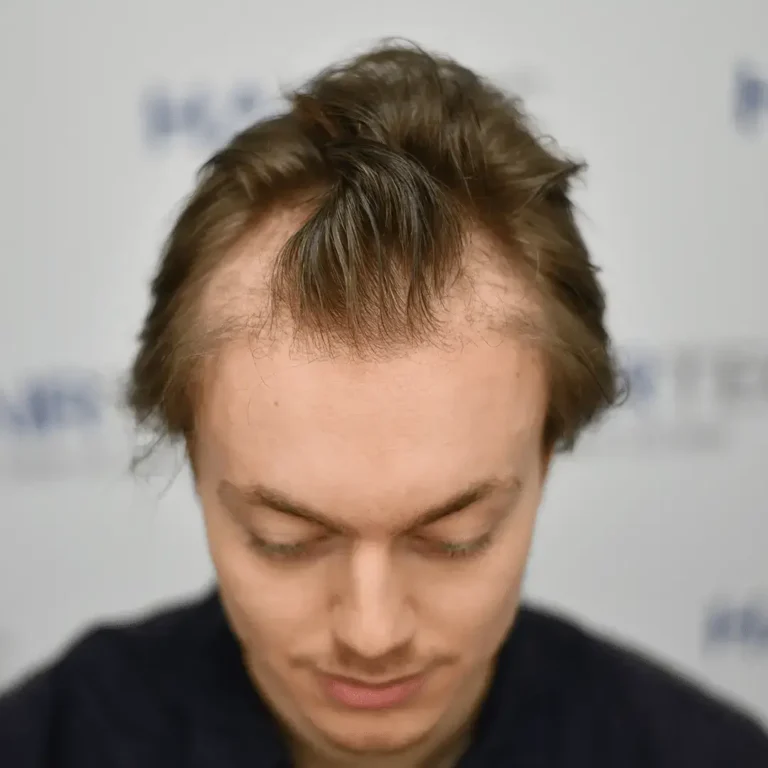 Jurriaan vóór de haartransplantatie, 2.330 grafts