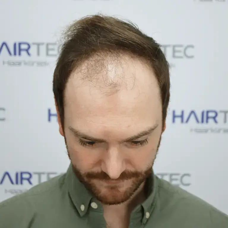 luke voor en na fotos voor