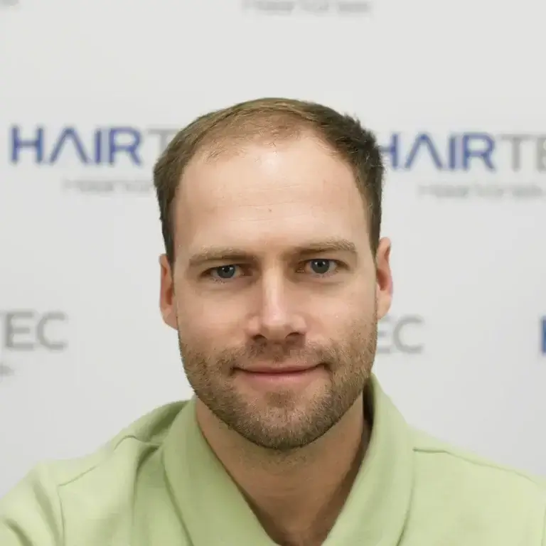 reimer voor haartransplantatie