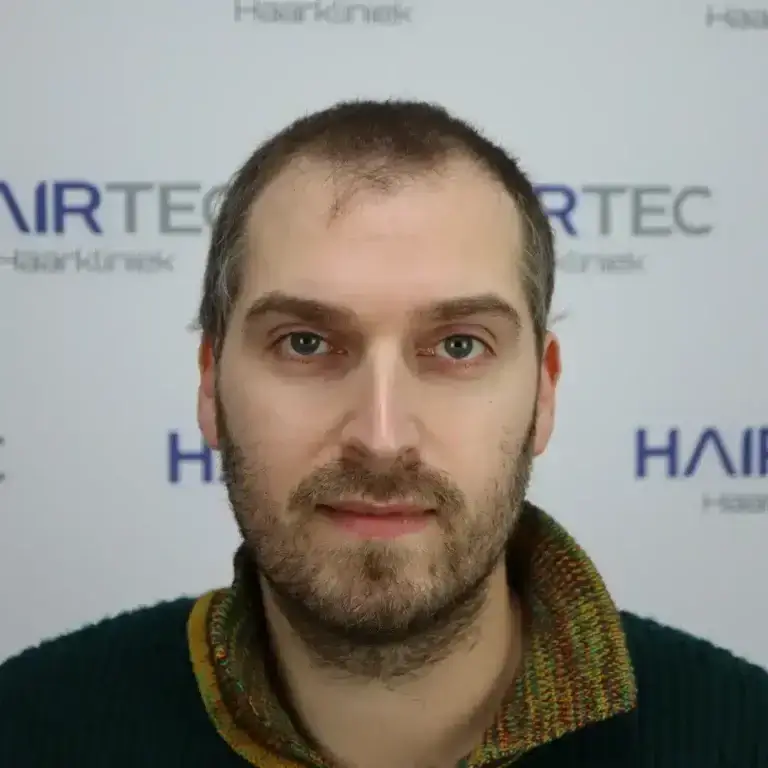 tom dice voor en na foto