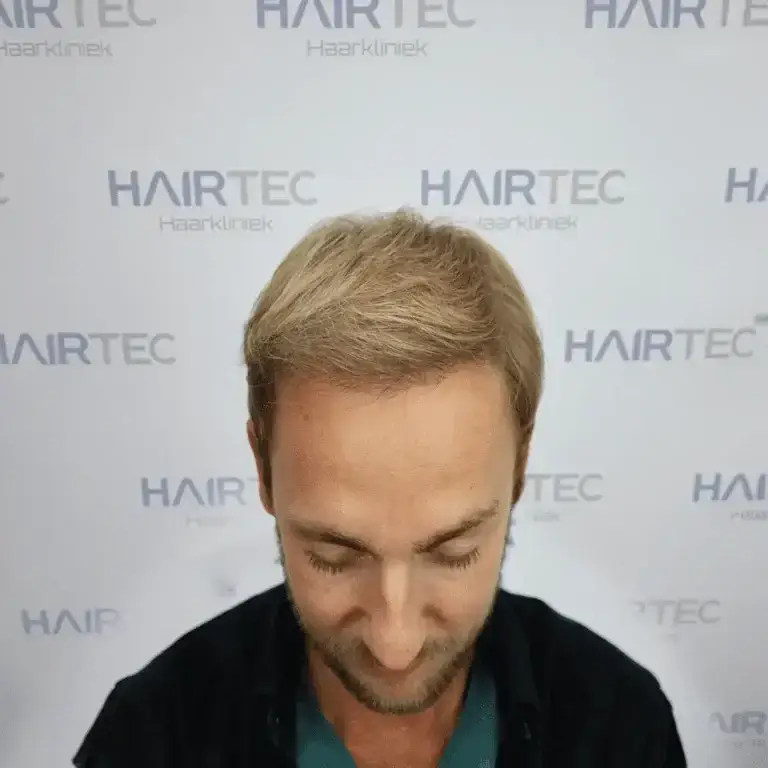 voor en na foto rick