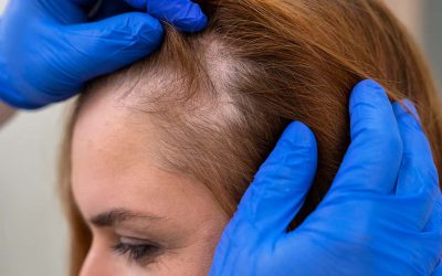 Dun haar en zichtbare hoofdhuid? Oorzaken en oplossingen