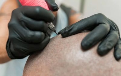 Haar pigmentatie: MHP voordelen en nadelen